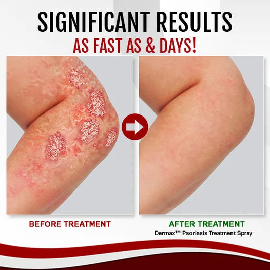 AnnieCareยฎ Psoriasis Treatment Spray๏ผVisible Change in 1 week!๏ผ