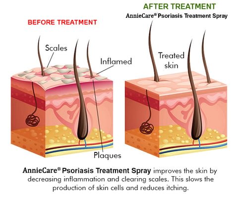 AnnieCare® Psoriasis Treatment Spray（Visible Change in 1 week!）