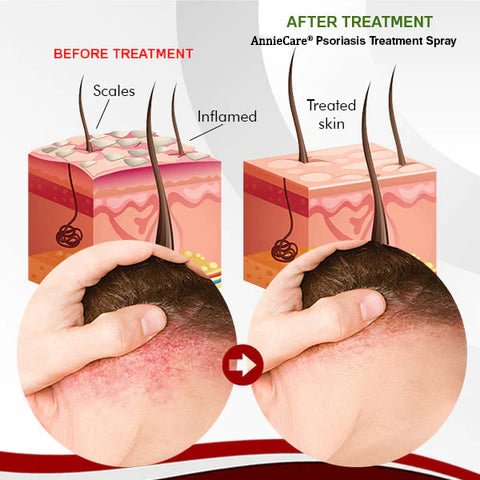 AnnieCare® Psoriasis Treatment Spray（Visible Change in 1 week!）
