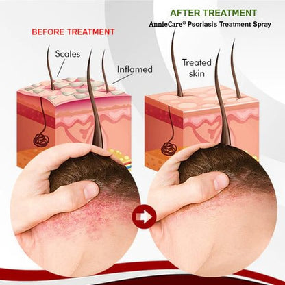 AnnieCare® Psoriasis Treatment Spray（Visible Change in 1 week!）