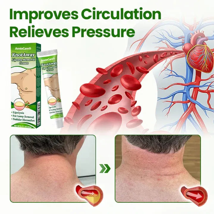 ⏰Last Day Promotion: 60% OFF🔥AnnieCare® KnotAway Lipoma Removal Cream