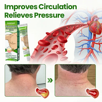 ⏰Last Day Promotion: 60% OFF🔥AnnieCare® KnotAway Lipoma Removal Cream