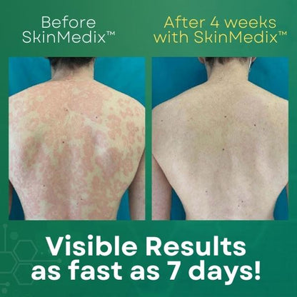 SkinMedix™ Upgraded Natural Herbaceous Plants Psoriasis Cream